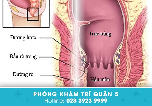Rò hậu môn là bệnh gì? Hình ảnh thực tế