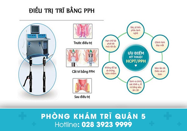 điều trị sa búi trĩ bằng kỹ thuật PPH